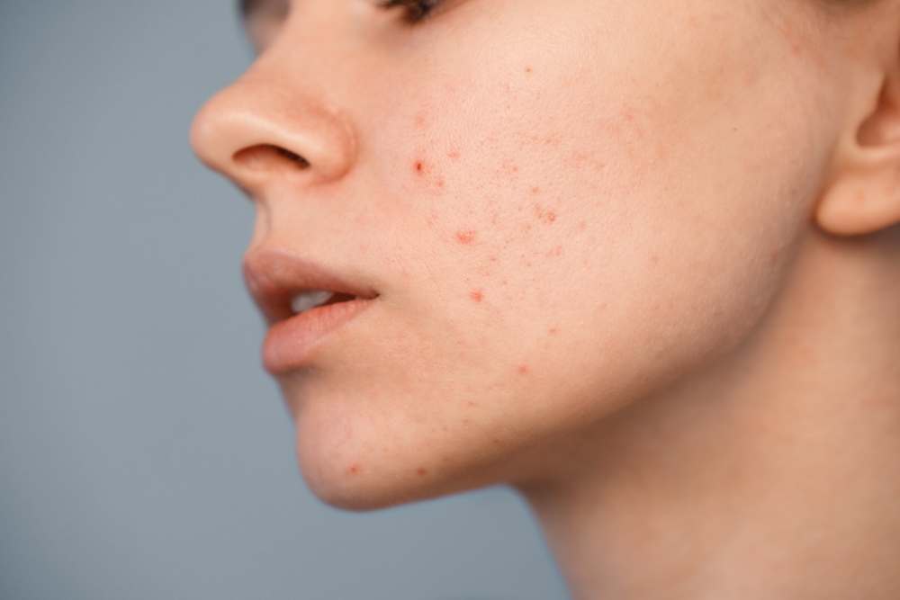 Acne